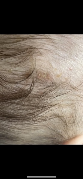 Rash and sores on daughter wanted advice!