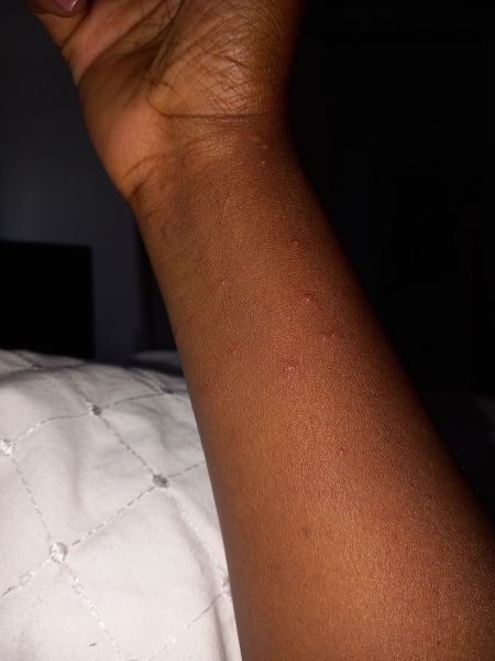Rapidly expanding rash