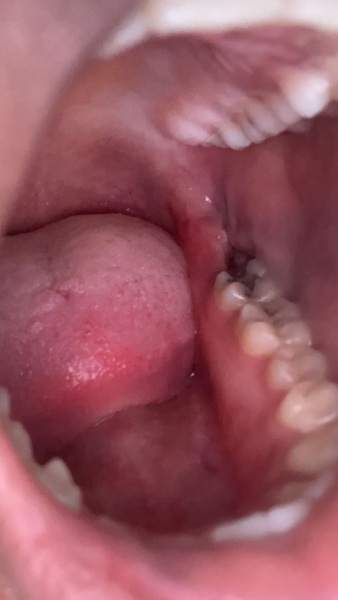 Anyone can tell me if this is dry socket or not just had my wisdom tooth taken out !