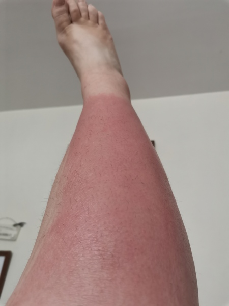 Chronic hives on boobs , PLS help .I’m miserable