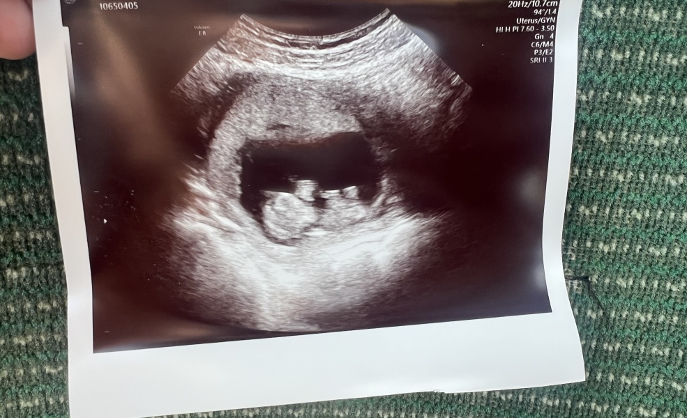 Ultrasound pic help