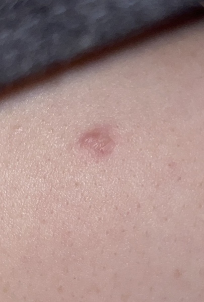 Scar or lump on boob