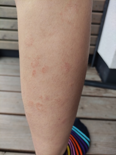 Anyone know about health care in Austria? (Eczema)