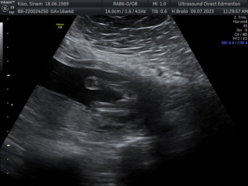 Anyone worried their private gender scan is wrong?