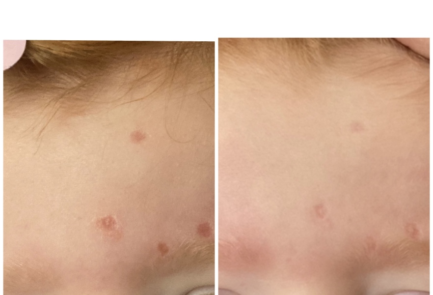 Large chicken pox scar