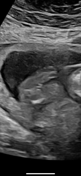 Anyone worried their private gender scan is wrong?