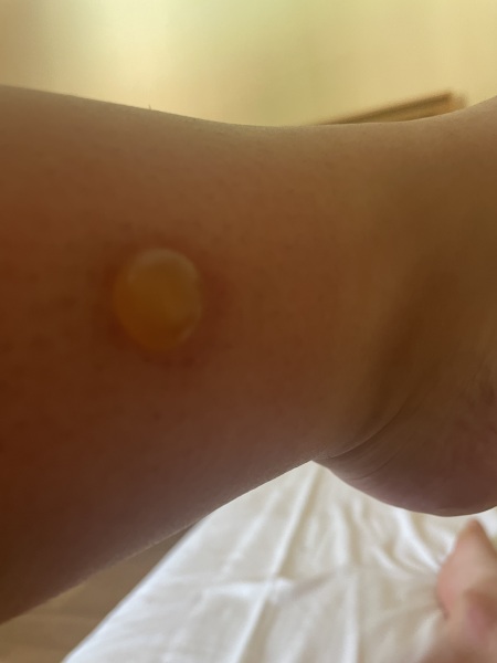 mosquito bite blisters