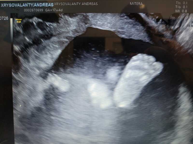 Ivf pregnancy - first trimester