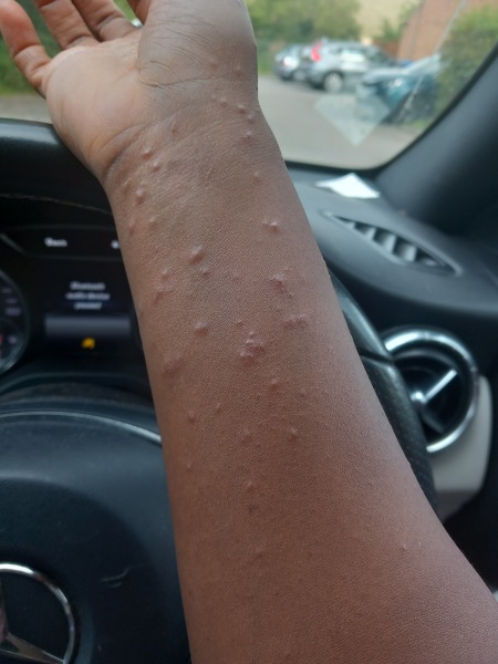 Rapidly expanding rash