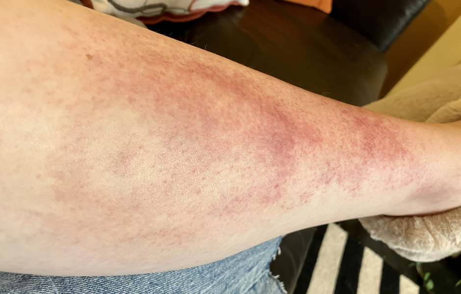 What have I been bitten by