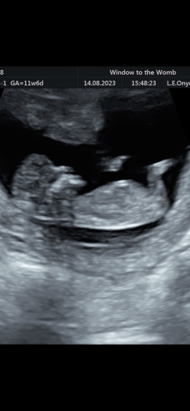 Weird scan anxiety