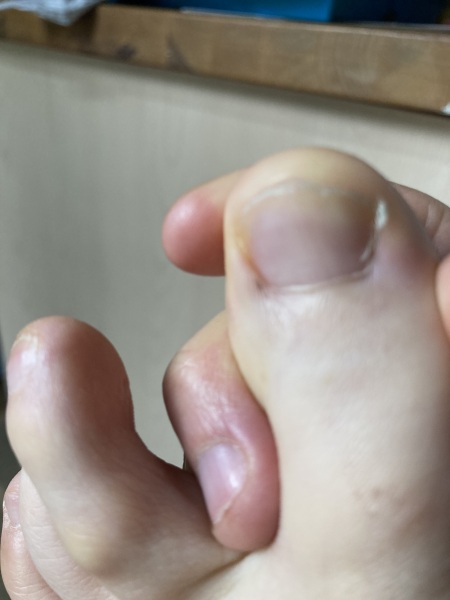 Dark line/mark near toe
