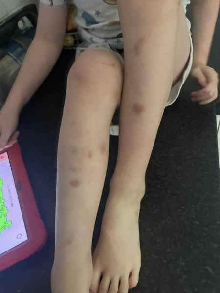Son's bruises