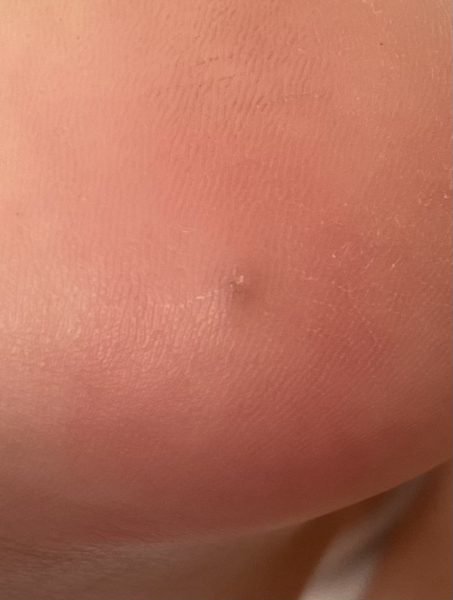 Verruca or something else?