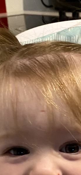 Toddler forehead scar