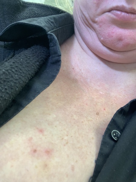Shingles again??  (Photo attached)