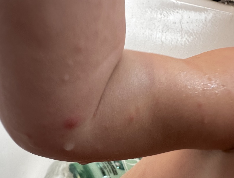 HF&M? Any advice on rash?