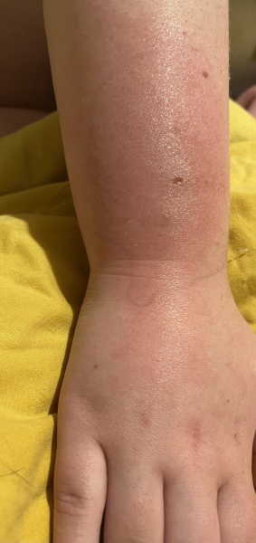 Dd bug bite (pic) antihistamines /ibuprofen anything else to help avoid antibiotics?