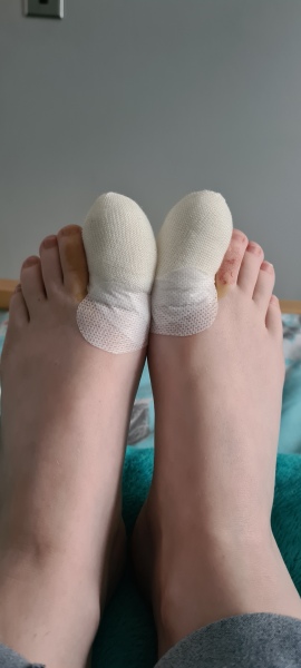Ingrown toenail