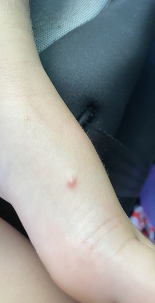 Molluscum Contagiosum?
