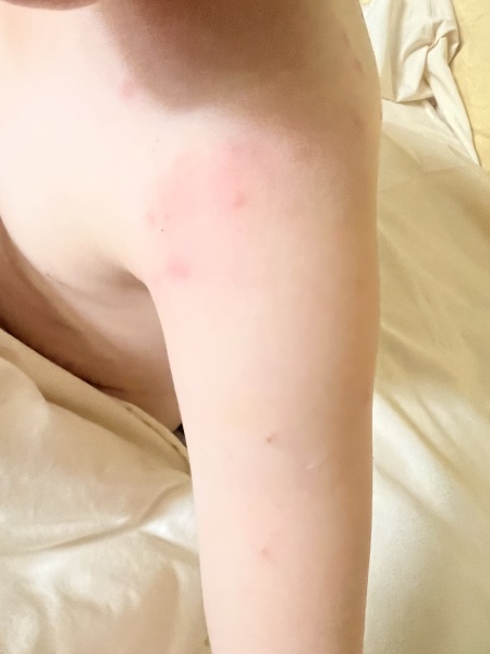 Bites or pox??