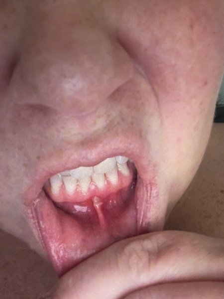 Ulcer/sore teeth