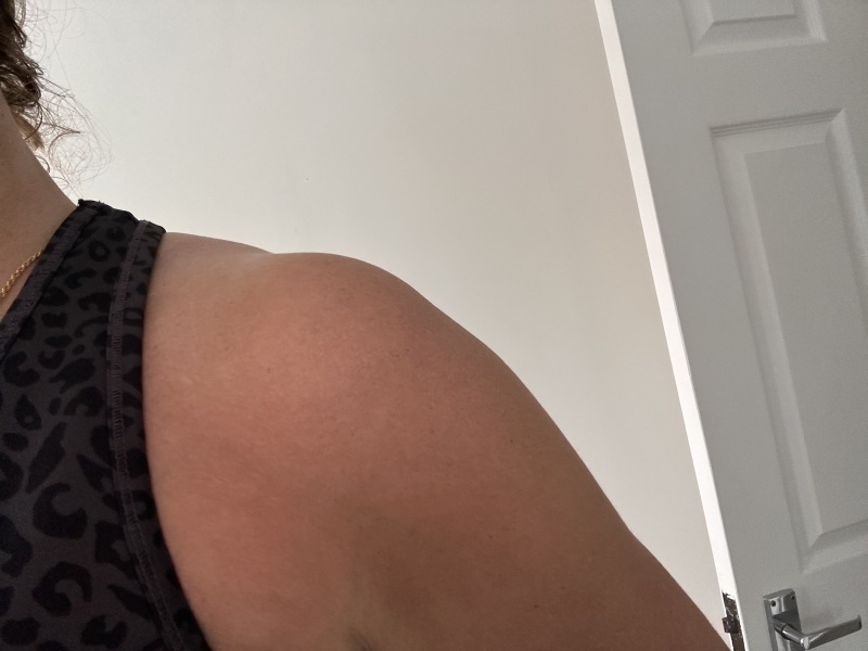 I had a breast reduction AMA