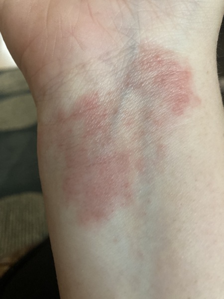 How to stop this rash