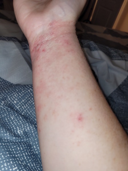 Eczema! what am I missing?