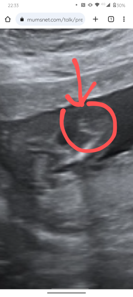 16+4 gender scan possibly wrong?