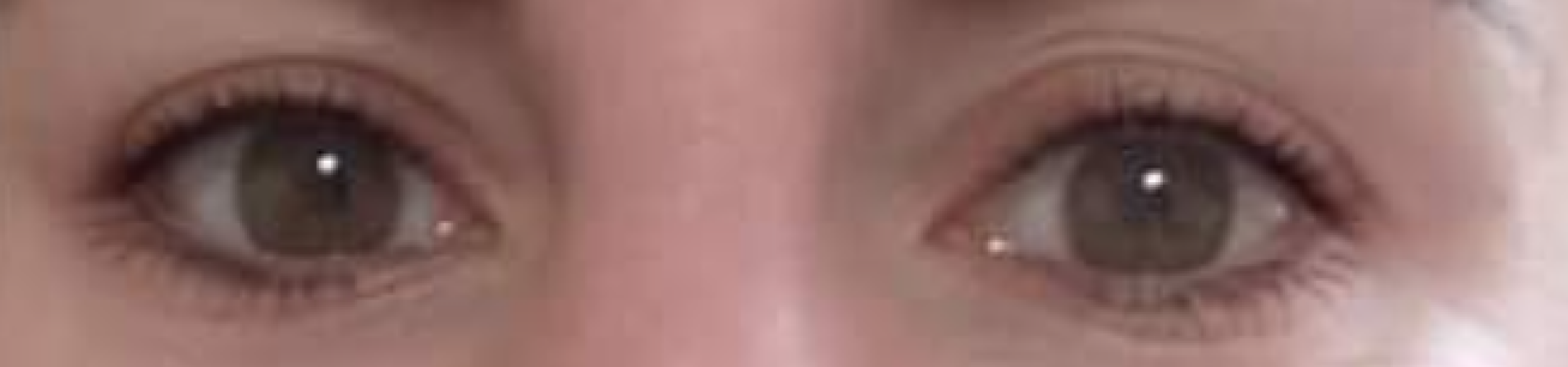 Are my uneven eyelids obvious?