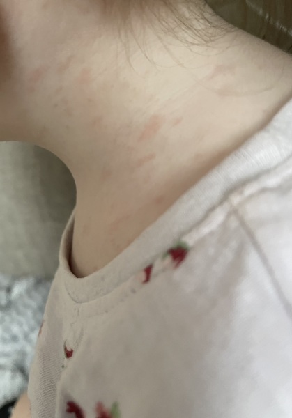What is this rash?