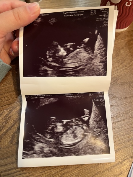 Boy or Girl - Nub/skull theory guesses?