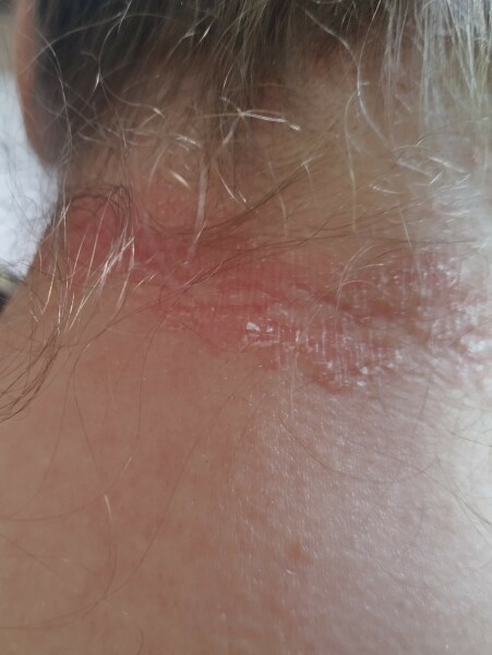 Does anyone know what this rash is?