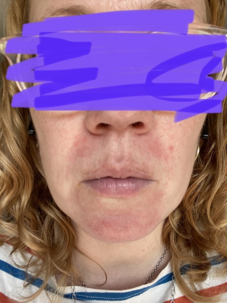 Is this rosacea?