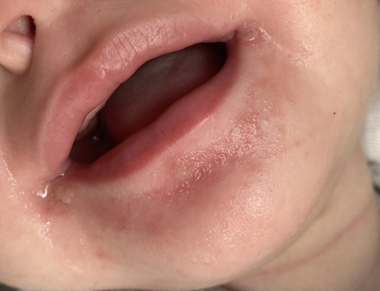 HELP is this a cold sore?? 10 months!