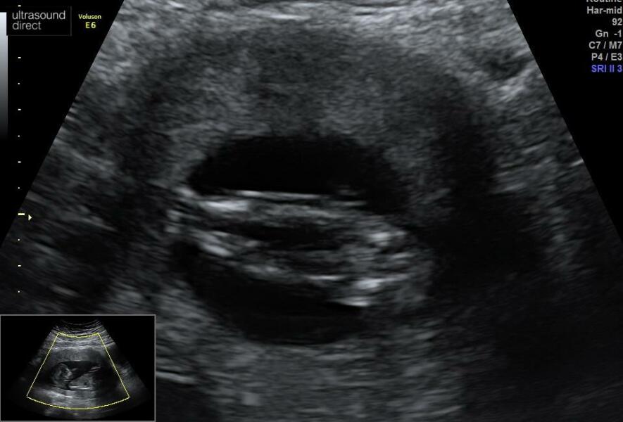 Gender guess, legs at 14 weeks