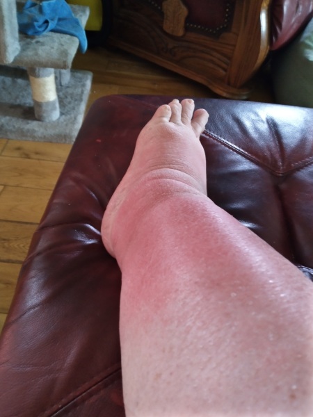 Is this cellulitis?