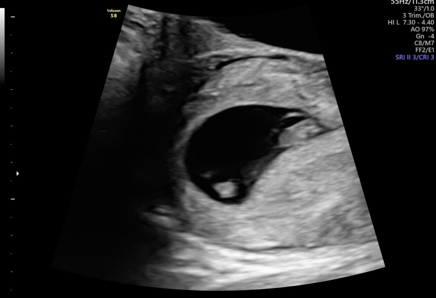 Early scan, twins?