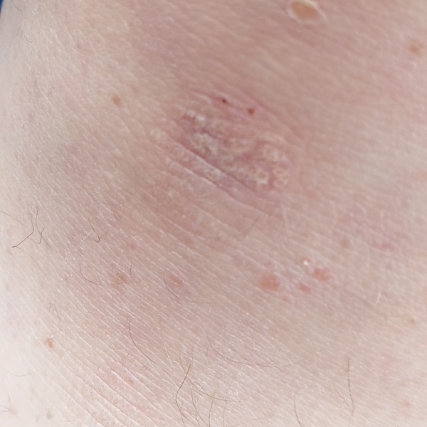 Does anyone know what this rash is?