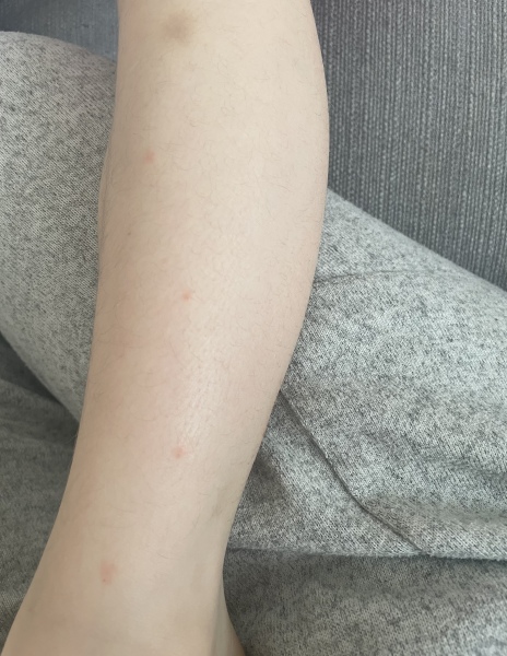 Bites but no other evidence - are they bed bugs
