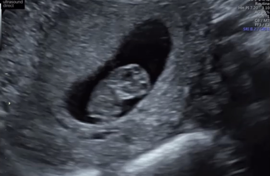 When did you hear baby’s heartbeat?