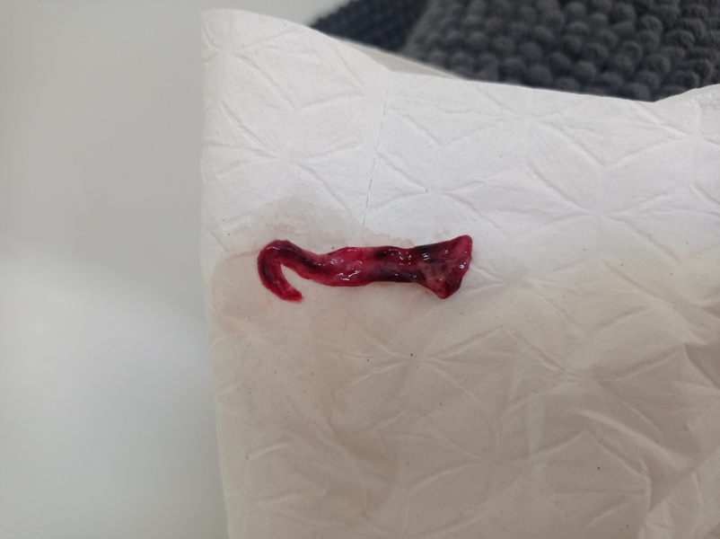 Miscarrying a posible ectopic. TW - picture