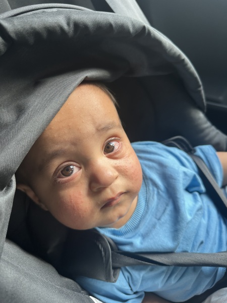 9 month old has eye infection that has caused a rash on his face?