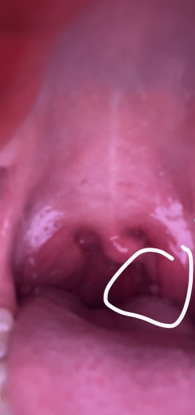 Wtf is this in the back of my throat?! ***GROSS picture***