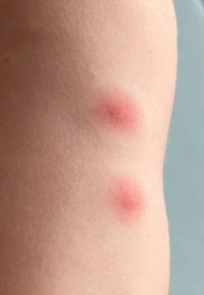 Could this be the start of chicken pox?