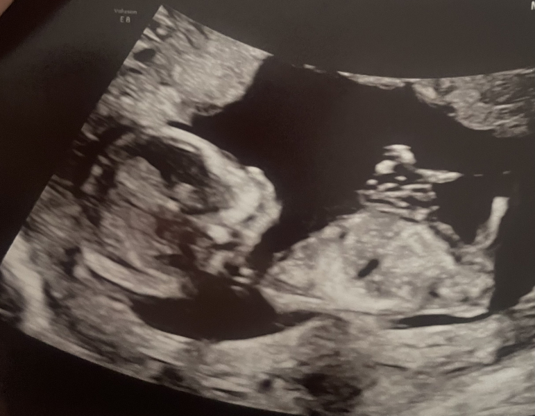 Place your random bets... nub/skull theory! 👶