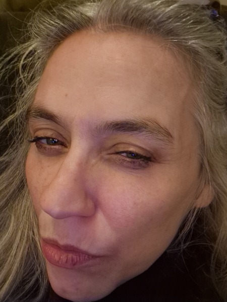 Milia in eye…help please?