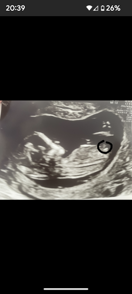 Any nub experts know if a nub is visible 🥰