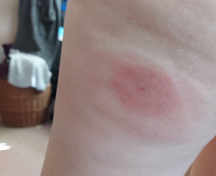 What is this rash 😧